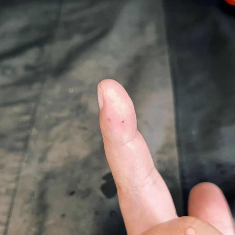 Wunde nach 5 Tagen nachdem der Haken aus dem Finger entfernt wurde